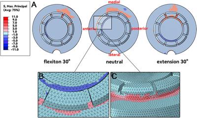 Cause analysis of the liner dissociation of a customized reverse shoulder prosthesis based on finite element analysis